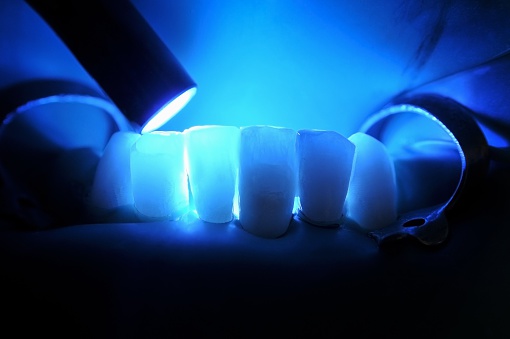 Close up of composite fillings from Grins & Giggles Family Dentistry in Spokane Valley, WA.
