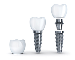 a diagram showing the parts of a dental implant at Grins & Giggles Family Dentistry in Spokane Valley, WA