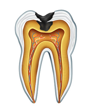 Illustrated diagram of a cavity from Grins & Giggles Family Dentistry in Spokane Valley, WA