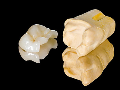 Dental inlays and onlays by Grins and Giggles Family Dentistry in Spokane Valley, WA.
