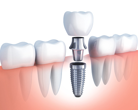 Rendering of dental implants from Grins & Giggles Family Dentistry in Spokane Valley, WA
