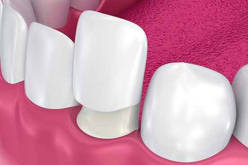 Diagram of Porcelain Veneers from Grins and Giggles Family Dentistry in Spokane Valley, WA