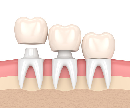 Dental crowns at Grins and Giggles Family Dentistry in Spokane Valley, WA 