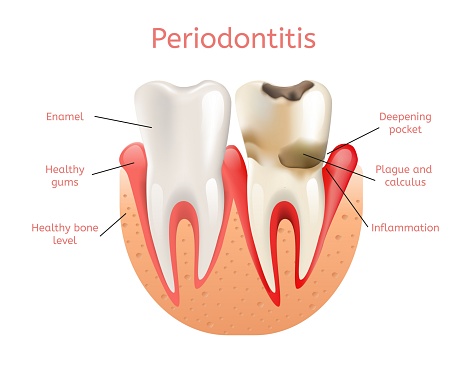 Periodontal disease treatment at Grins and Giggles Family Dentistry in Spokane Valley, WA 