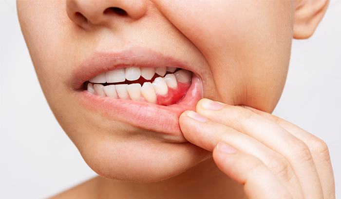 a woman with swollen gums showing her teeth