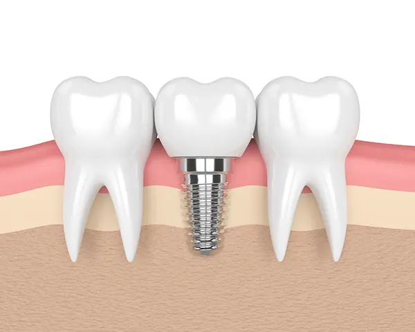 3D rendered cross-section view of a dental implant placed in the jaw between two healthy teeth illustrated by Grins & Giggles Family Dentistry in Spokane Valley, WA 3D rendered cross-section view of a dental implant placed in the jaw between two healthy teeth illustrated by Grins & Giggles Family Dentistry in Spokane Valley, WA