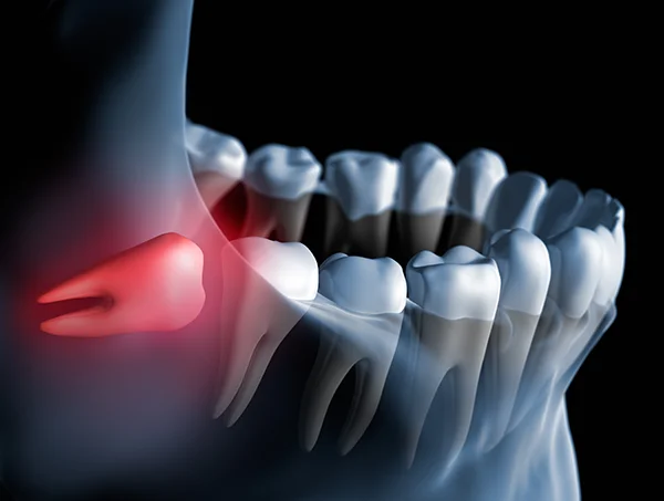 3D rendered xray of an impacted wisdom tooth butting against the tooth next to it illustrated by Grins & Giggles Family Dentistry in Spokane Valley, WA