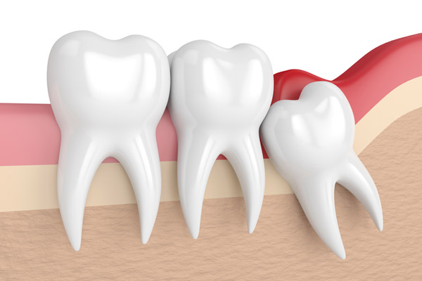 Illustration of an impacted wisdom tooth at Grins & Giggles Family Dentistry in Spokane Valley, WA