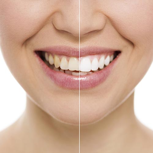 Before and after of teeth whitening treatment at Grins & Giggles Family Dentistry in Spokane Valley, WA