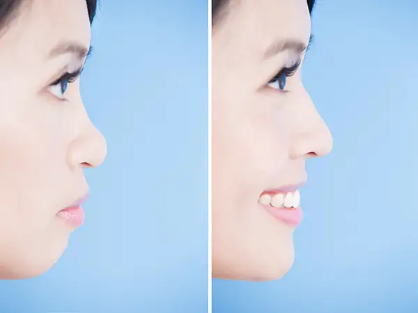 Side-by-side profile comparison of a woman before and after cosmetic dental treatment at Grins & Giggles Family Dentistry in Spokane Valley, WA