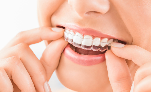 Woman placing her customized mouthguard on her teeth by Grins & Giggles Family Dentistry in Spokane Valley, WA